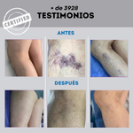 Varicose Veins™ | Piernas Ligeras y Sin Pesadez 💙